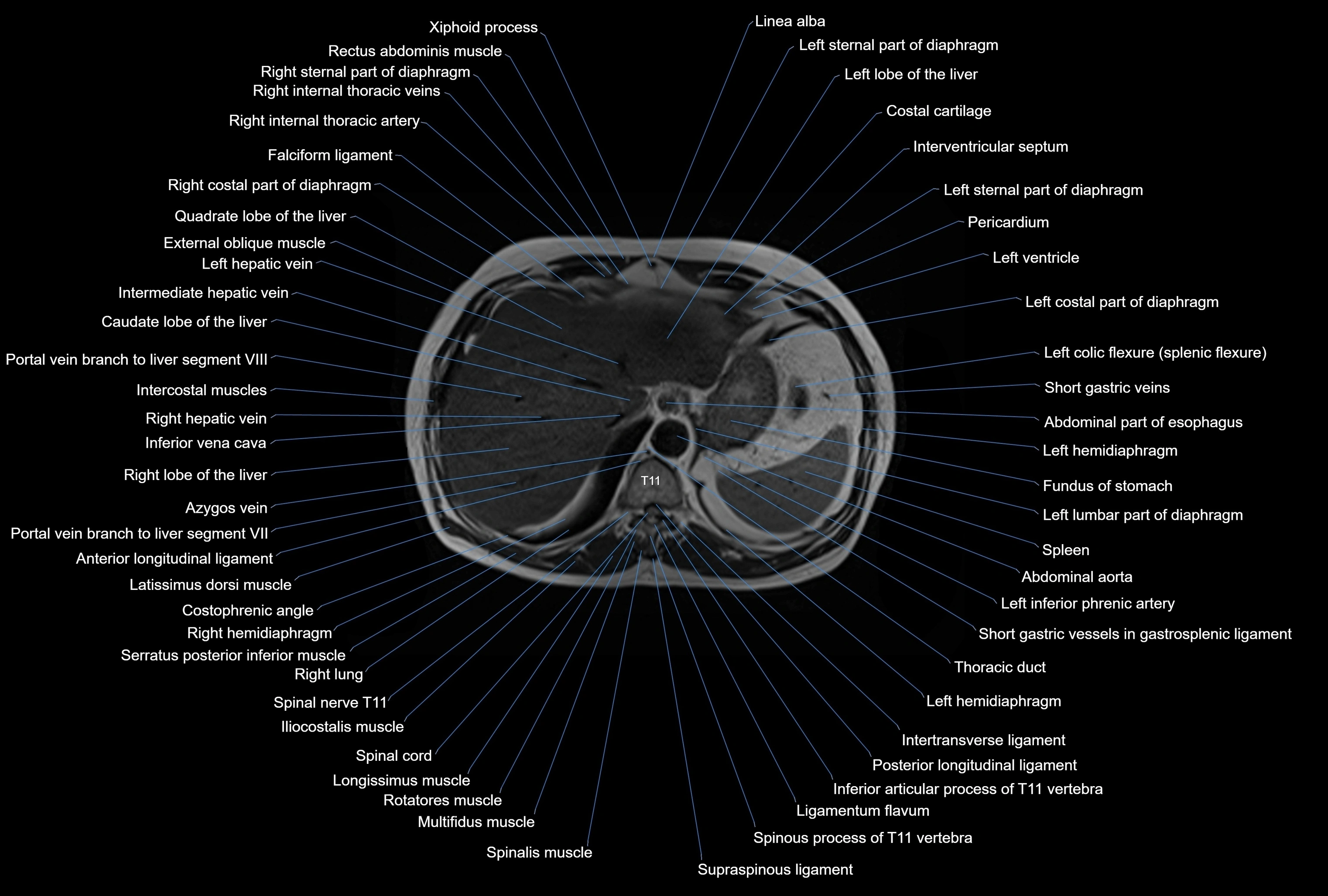 MRI Abdomen axial cross sectional anatomy radiology  image-img-00001-00008.webp
